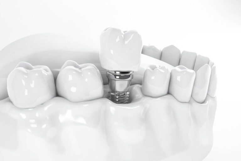 Dental Implants 11